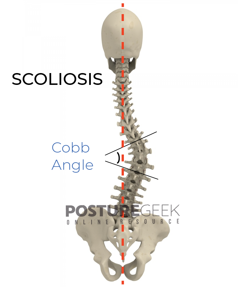 Scoliosis Cobb Angle