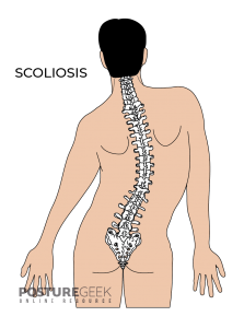 Scoliosis