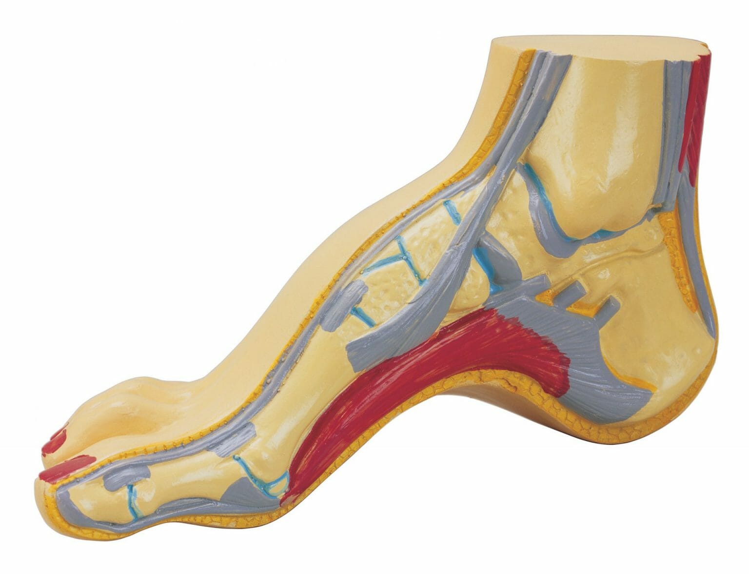 What is plantar fasciitis?