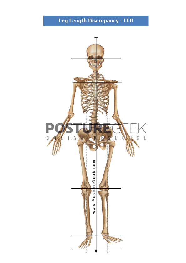 Shoe Lift - Nonsurgical Treatment - Leg Length Discrepancy