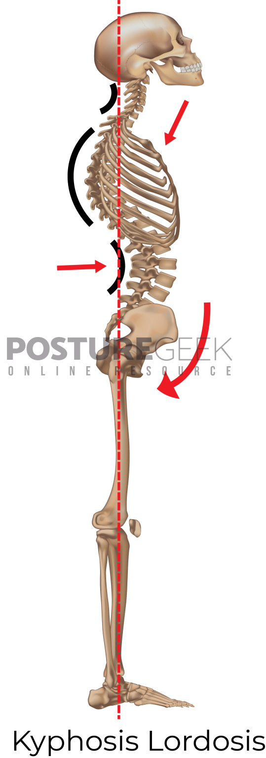Kyphosis Lordosis Posture