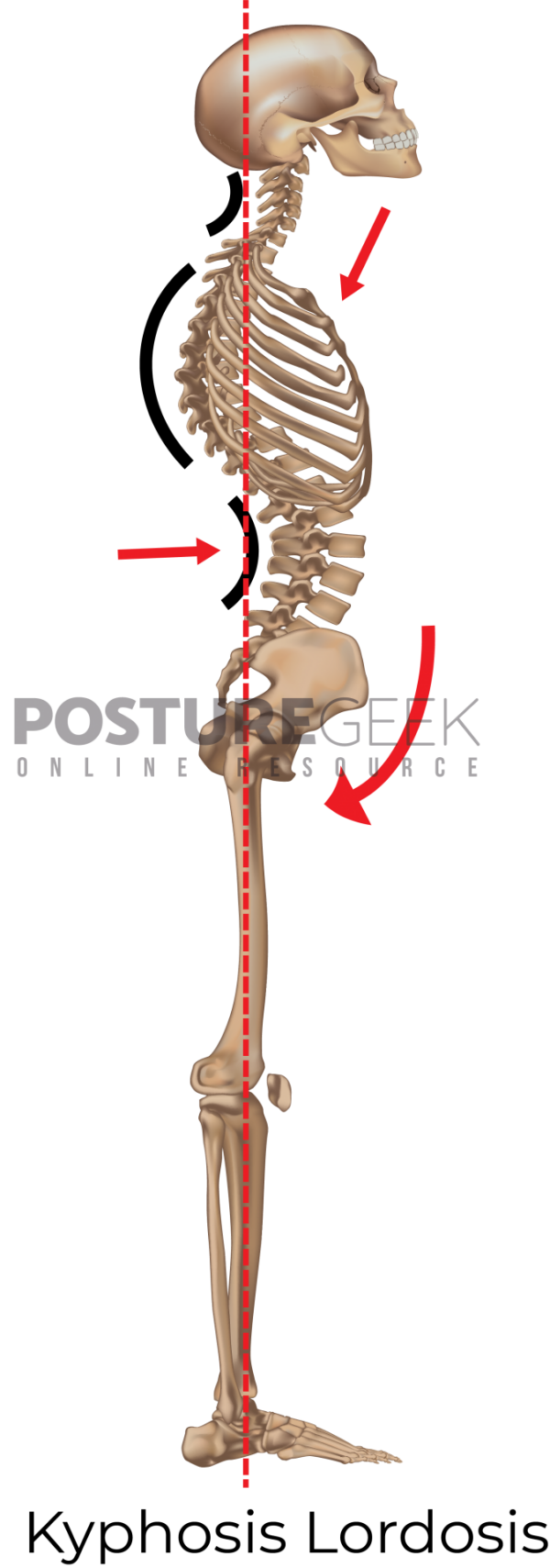 Kyphosis Lordosis Posture