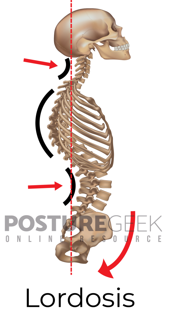 WHAT IS LORDOSIS? Posture Geek