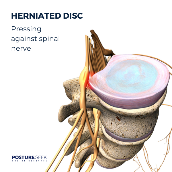 Degenerative Disc Disease
