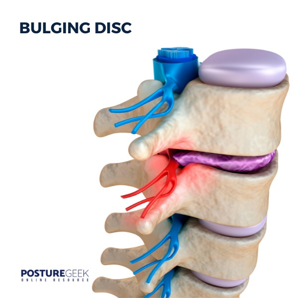 Degenerative Disc Disease