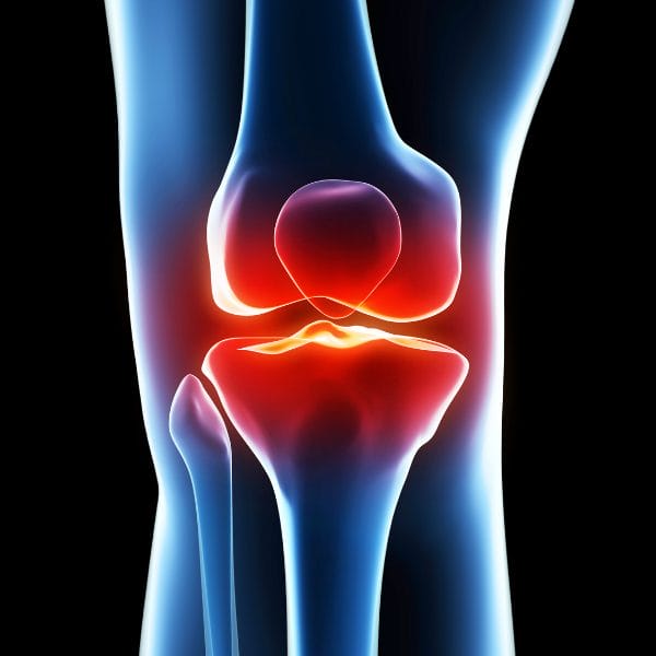 Inflammation of the knee joint