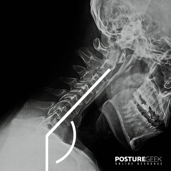 Text Neck and impact the cervical spine