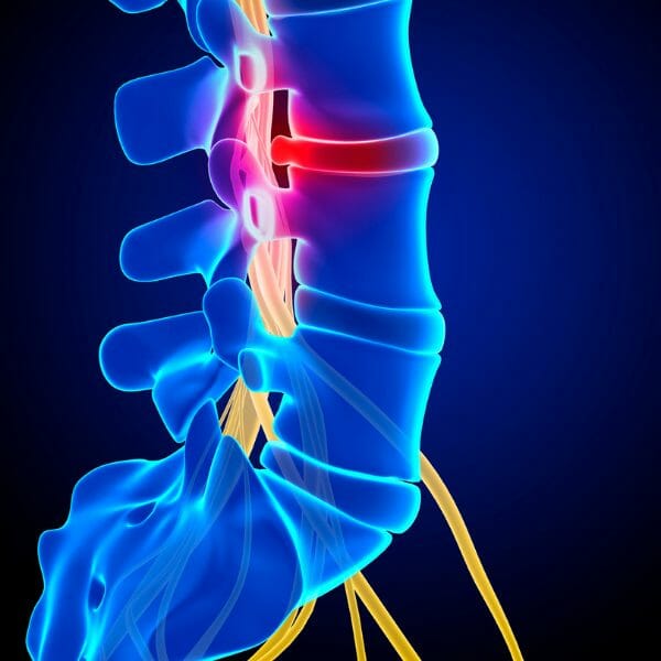 Herniated Disc