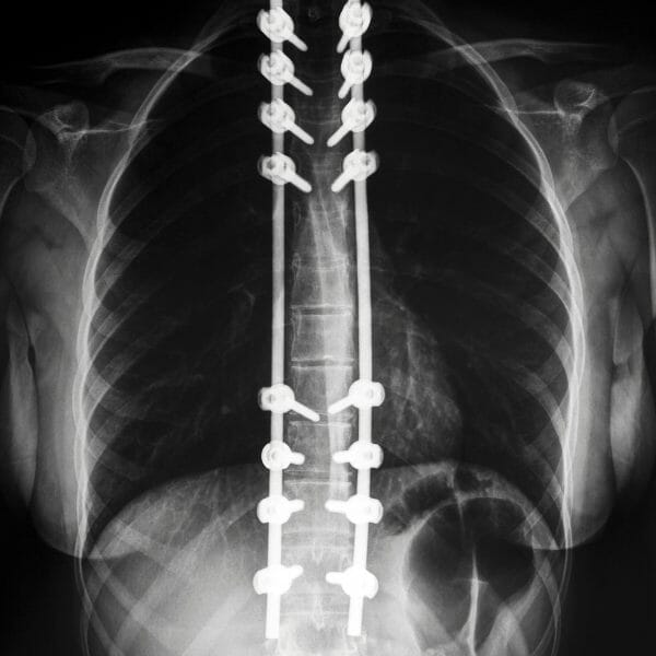 Spinal surgery for scoliosis