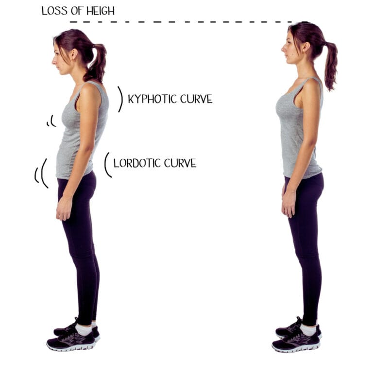 Kyphosis Lordosis Posture