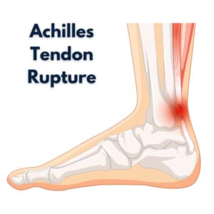 Ruptured achilles tendon